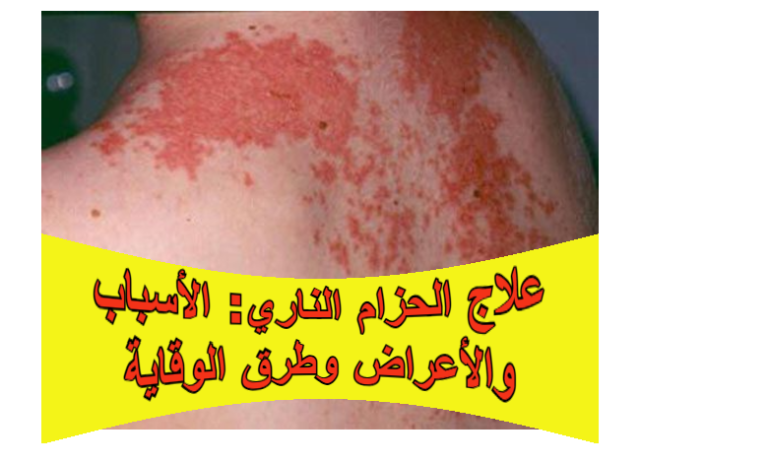 علاج الحزام الناري: الأسباب والأعراض وطرق الوقاية