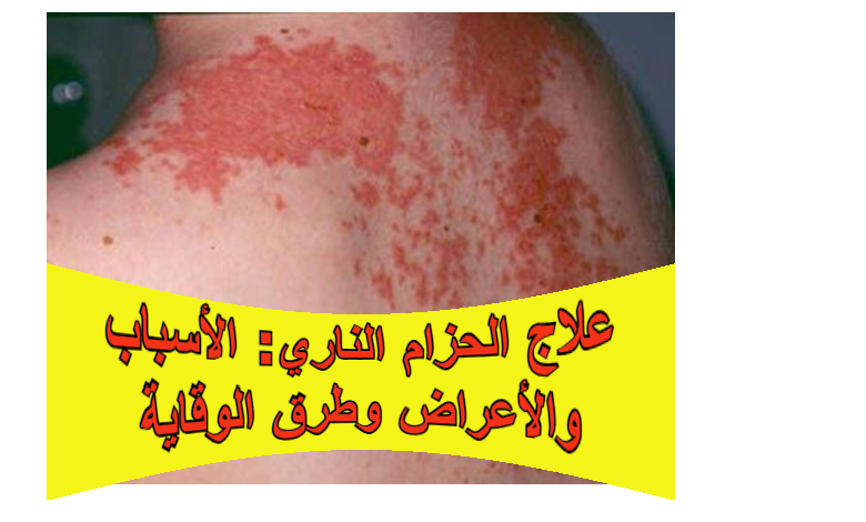 علاج الحزام الناري: الأسباب والأعراض وطرق الوقاية