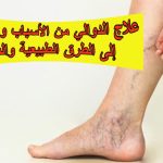 علاج الدوالي: من الأسباب والأعراض إلى الطرق الطبيعية والطبية