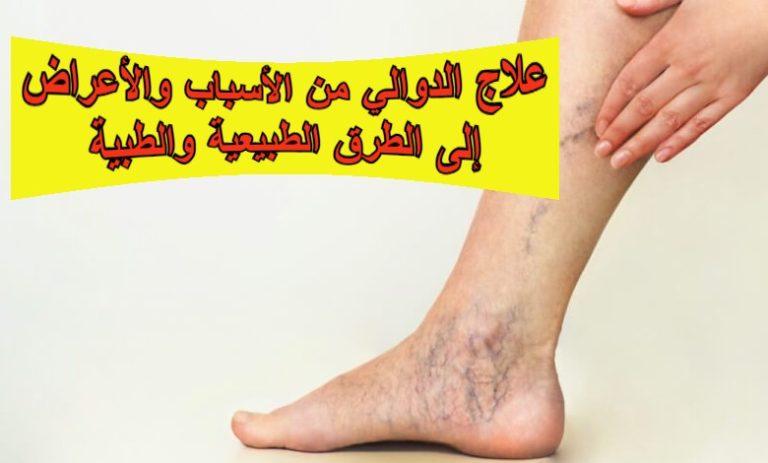علاج الدوالي: من الأسباب والأعراض إلى الطرق الطبيعية والطبية