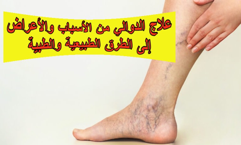 علاج الدوالي: من الأسباب والأعراض إلى الطرق الطبيعية والطبية