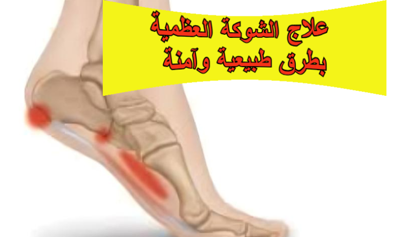 علاج الشوكة العظمية بطرق طبيعية وآمنة