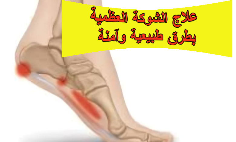 علاج الشوكة العظمية بطرق طبيعية وآمنة