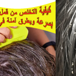 كيفية التخلص من قمل الرأس بسرعة وبطرق آمنة في المنزل