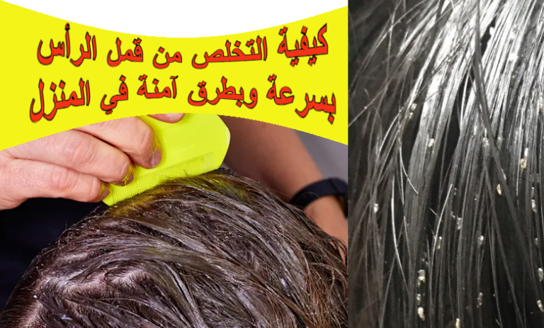 كيفية التخلص من قمل الرأس بسرعة وبطرق آمنة في المنزل