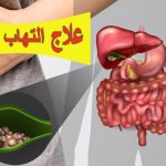 علاج التهاب المرارة: الأسباب، الأعراض، المضاعفات وطرق الوقاية