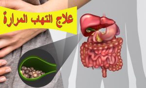 علاج التهاب المرارة: الأسباب، الأعراض، المضاعفات وطرق الوقاية